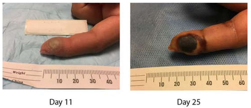 Illustration for article titled Esta es la evolución de un dedo que accidentalmente se ha infectado con un virus de la viruela